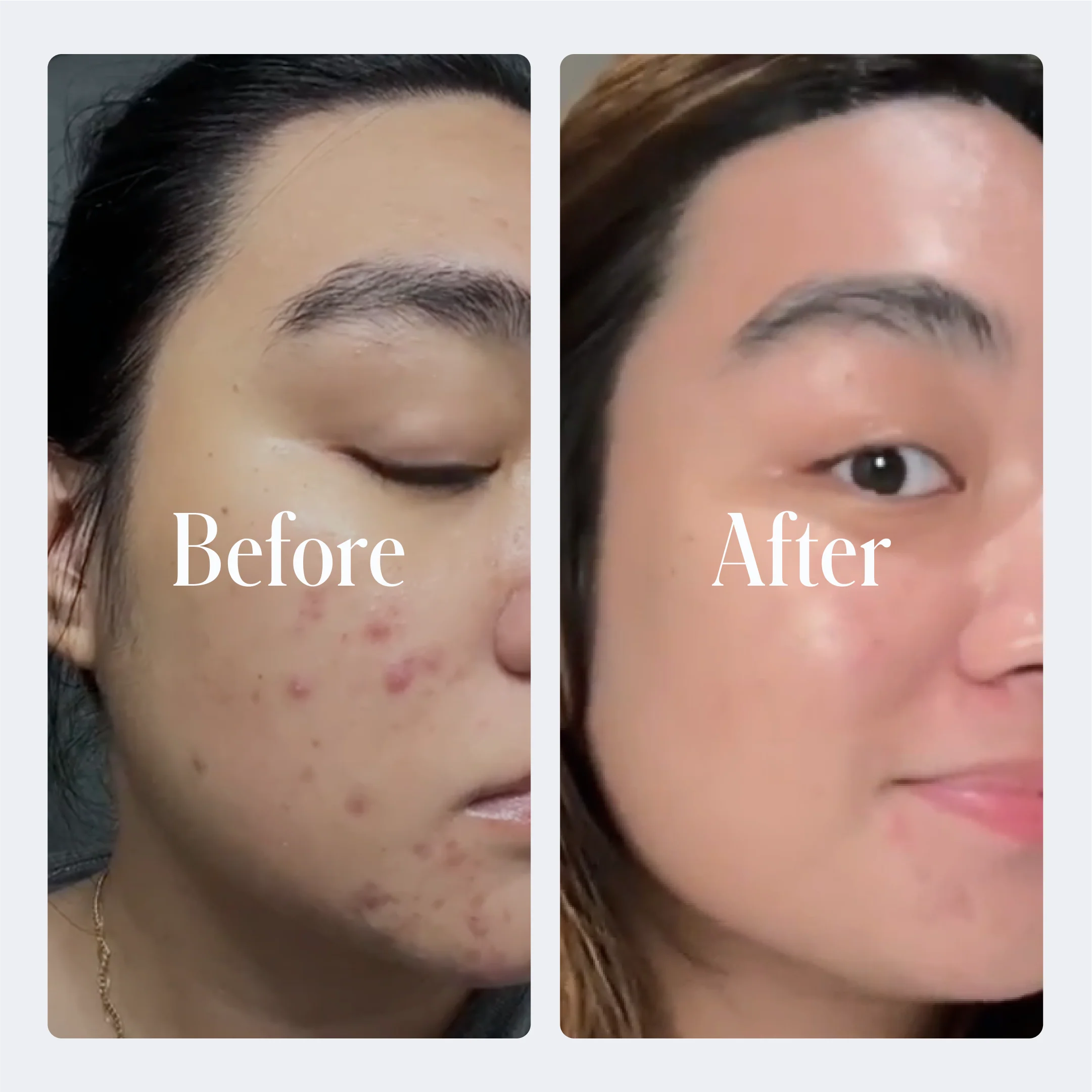 Geologie Acne Starter Kit - Image 2